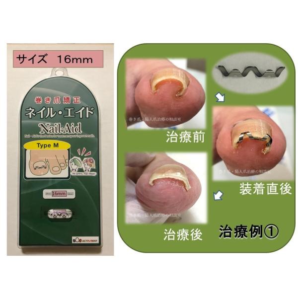 巻き爪治療 巻き爪矯正 自分で ネイルエイド 16mm ワイヤー